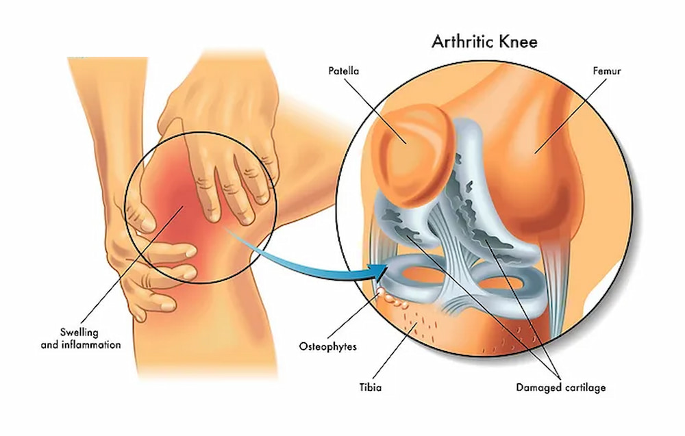 Arthritis illustrate