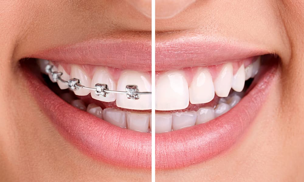 Braces or Invisiline, appearance beauty