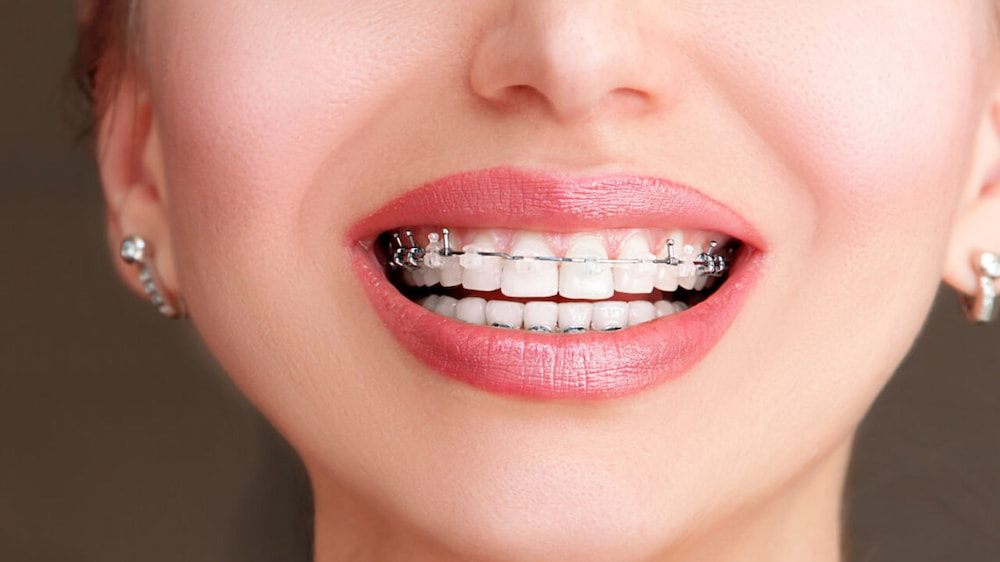 Metal braces for teeth strightening