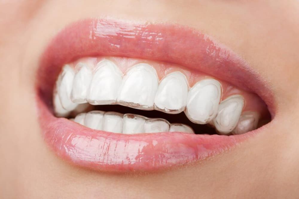 Braces or Invisalign, oral hygiene