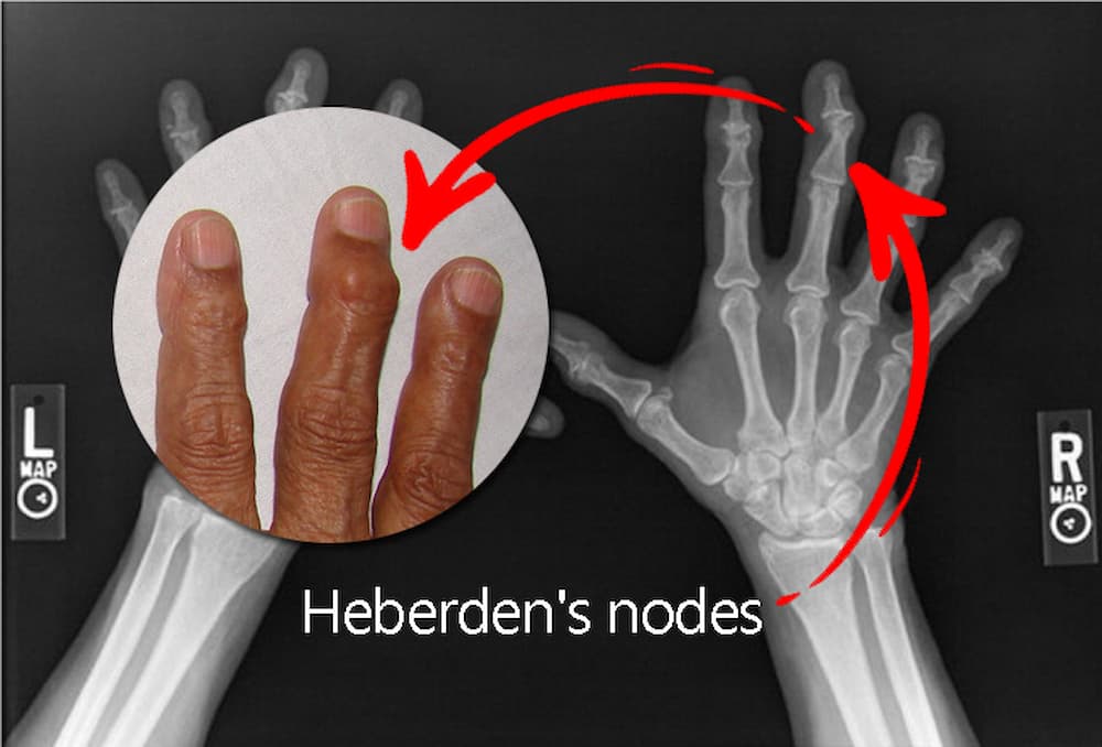 Heberden's nodes