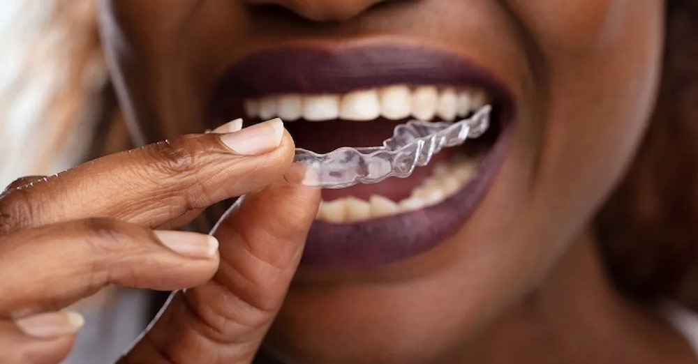 Braces or Invisalign, eating restrictions