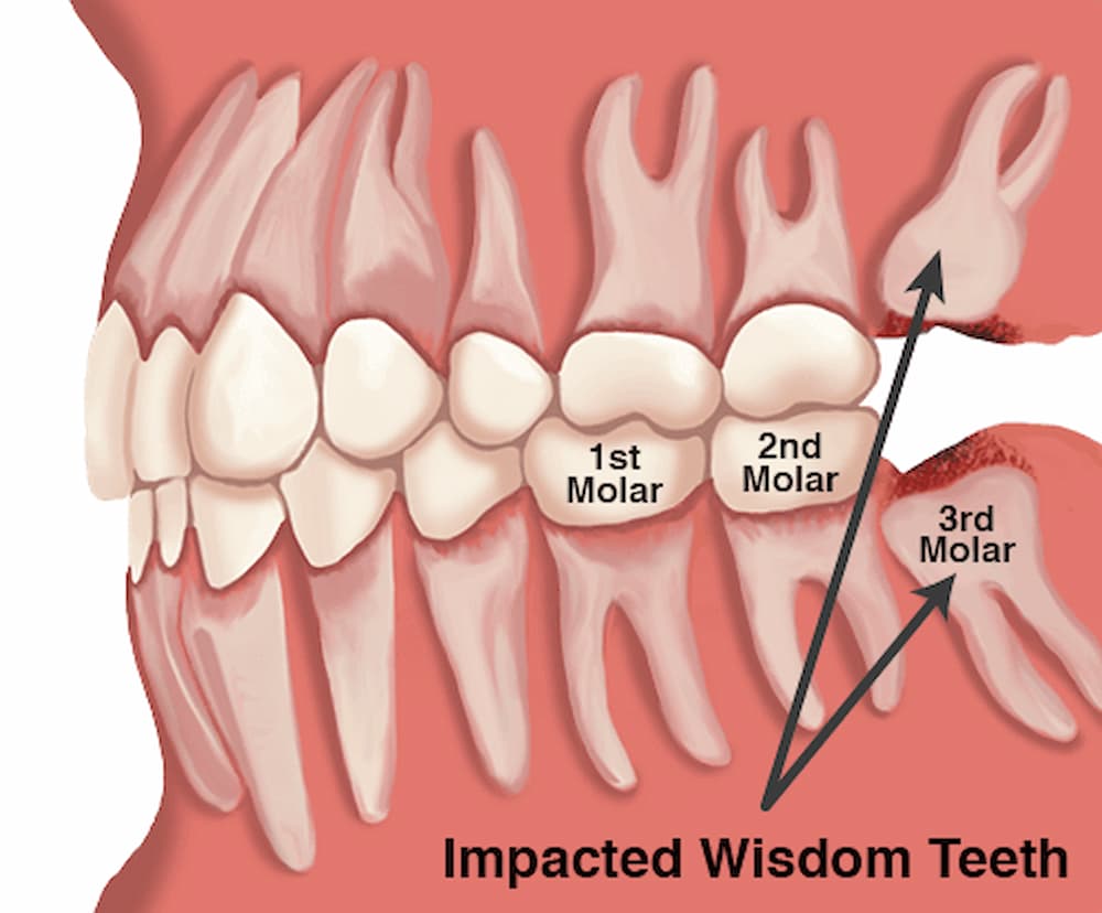 Wisdom teeth and dental pain