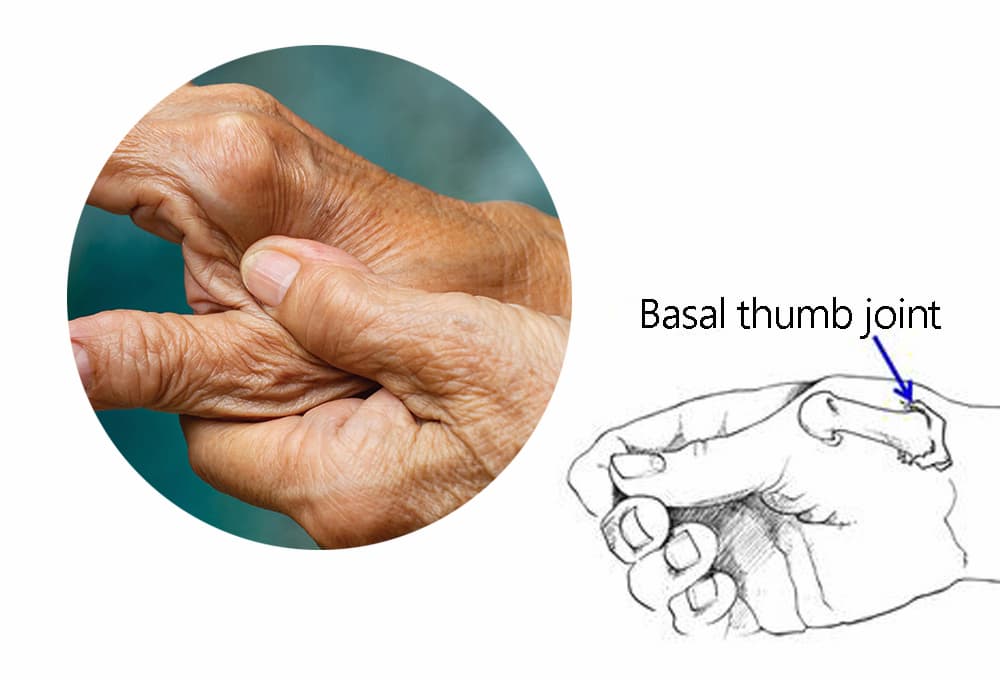 Basal arthritis of the thumb