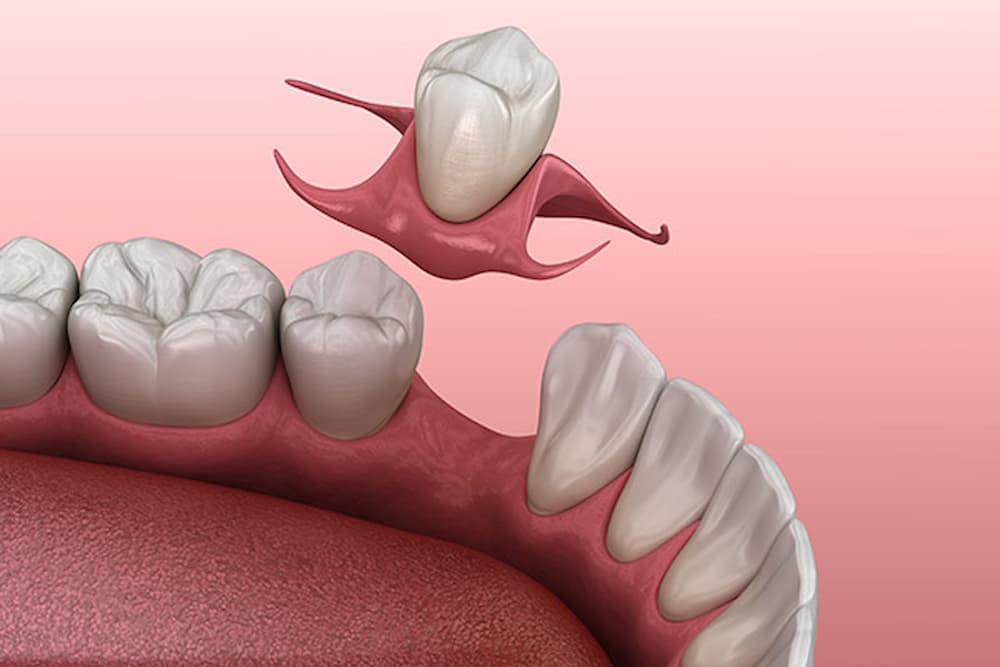 Teeth adjacent to artificial teeth