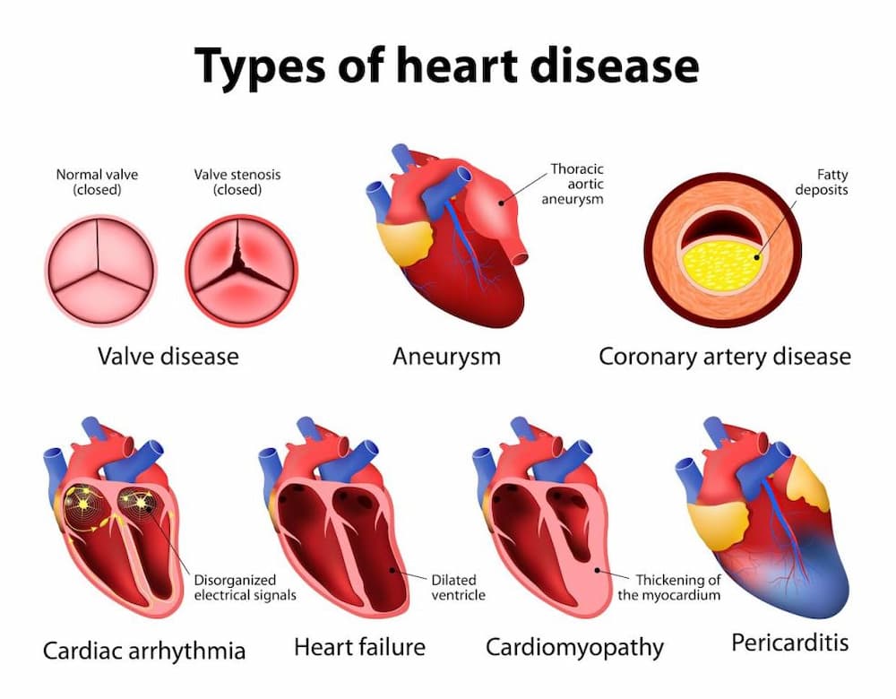 types of heart diseases