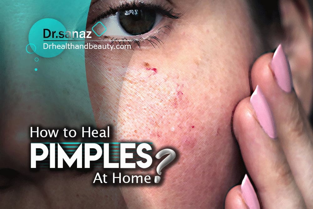 how to heal-pimples-at-home