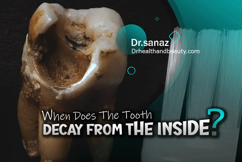 When Does The Tooth Decay From The Inside?