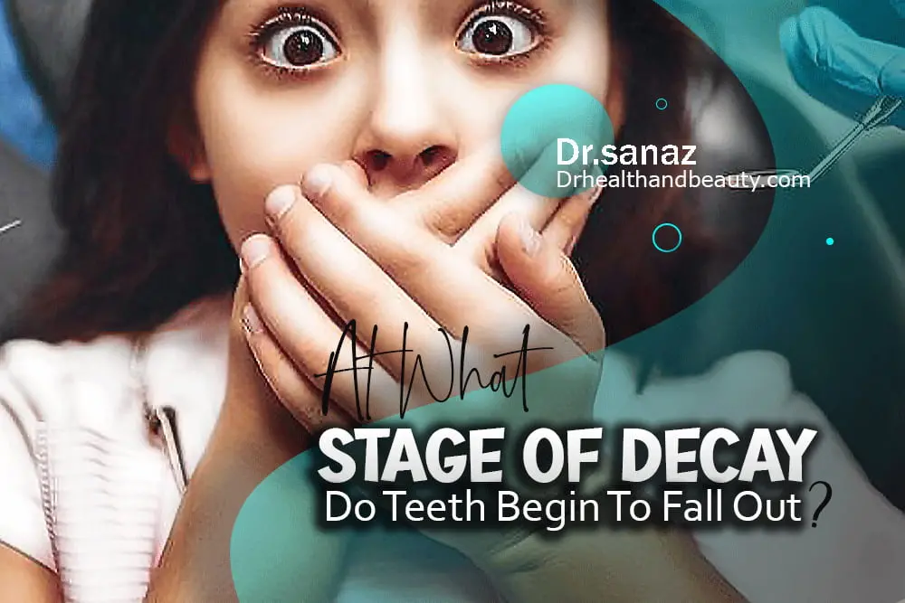 At What Stage Of Decay Do Teeth Begin To Fall Out?