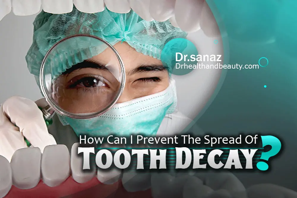 How Can I Prevent The Spread Of Tooth Decay?