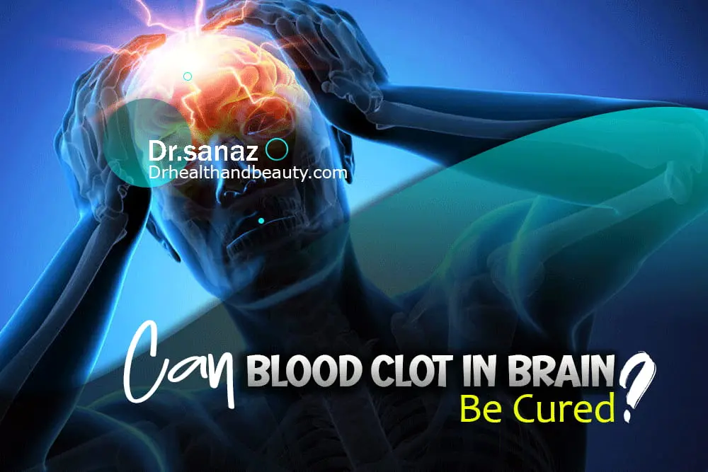 Can Blood Clot In Brain Be Cured?