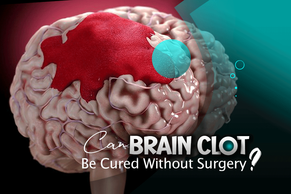 Can-brain-clot-be-cured-without-surgery?