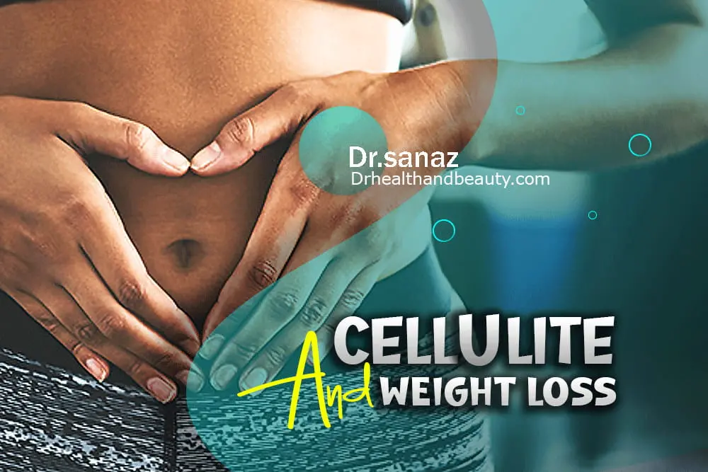 Will cellulite go away with weight loss?
