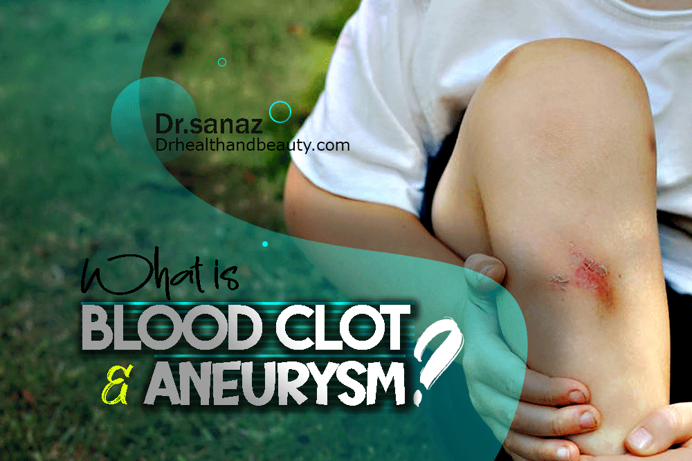 What Are Blood Clots And Aneurysms