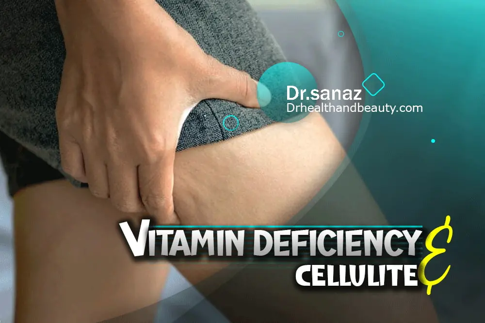 Vitamin Deficiency And Cellulite