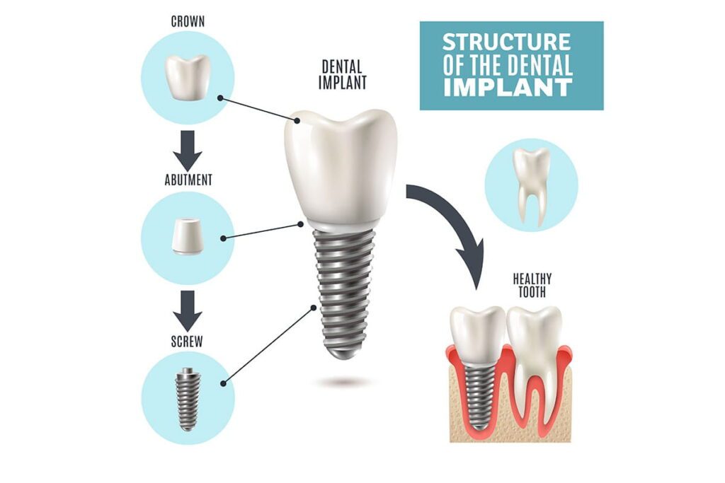 structure of dental implant 215400