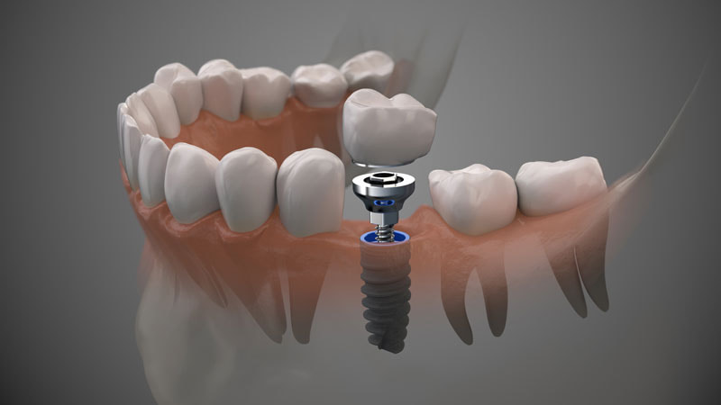 What Is The Most Painful Part Of A Dental Implant? 02