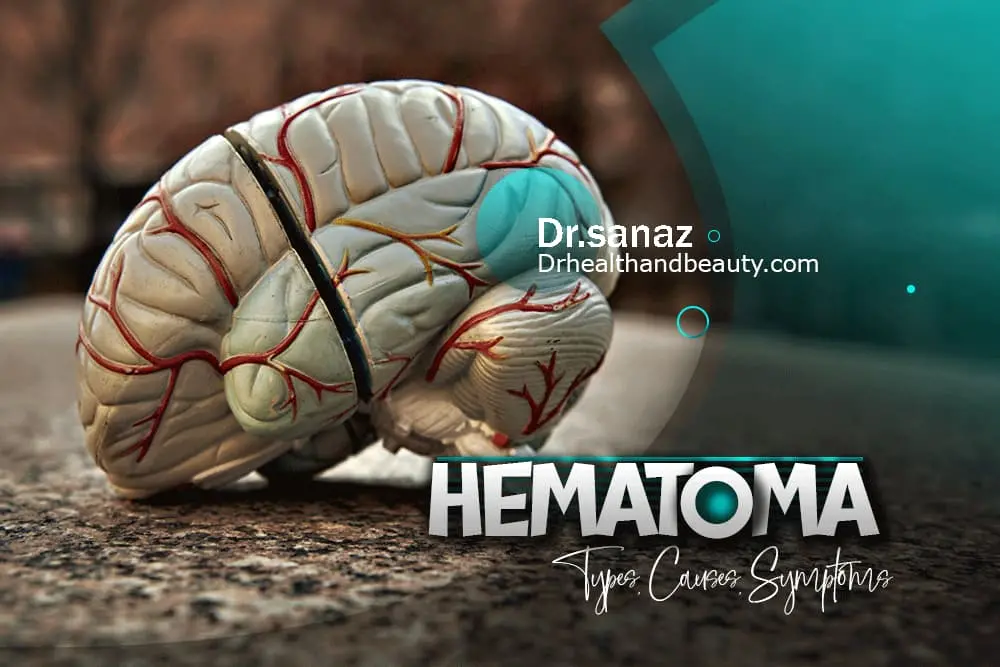 Hematoma-Types-Causes-Symptoms