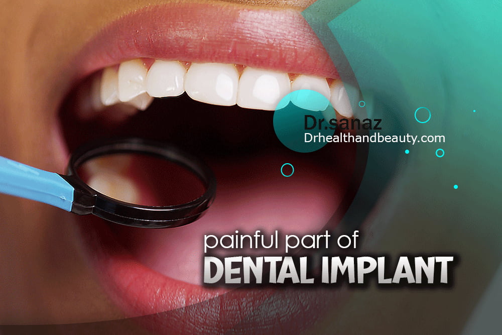What is the most painful part of a dental implant?