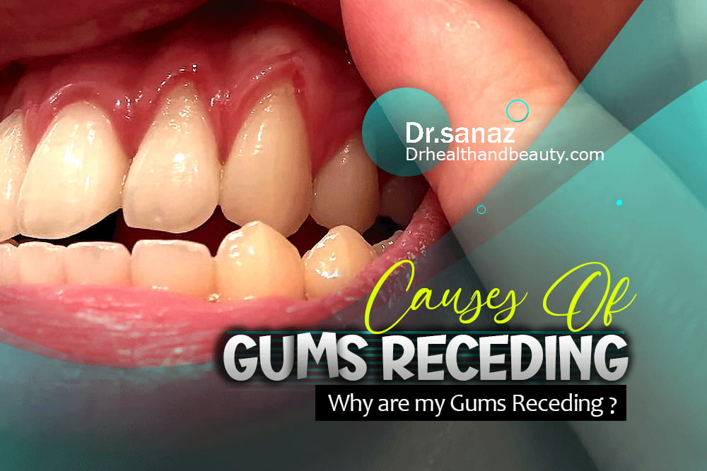 Why are my Gums Receding?