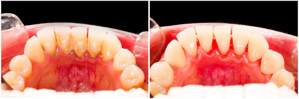 Deep Cleaning Teeth Or Dental Scaling 014