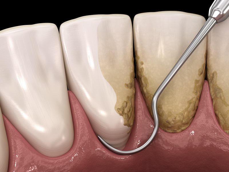 What is the best method of scaling teeth? 1254359
