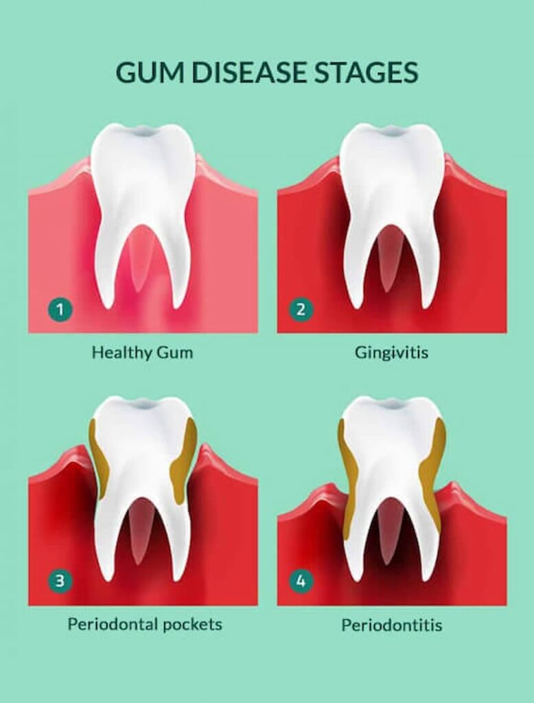 gum disease stages 00140015