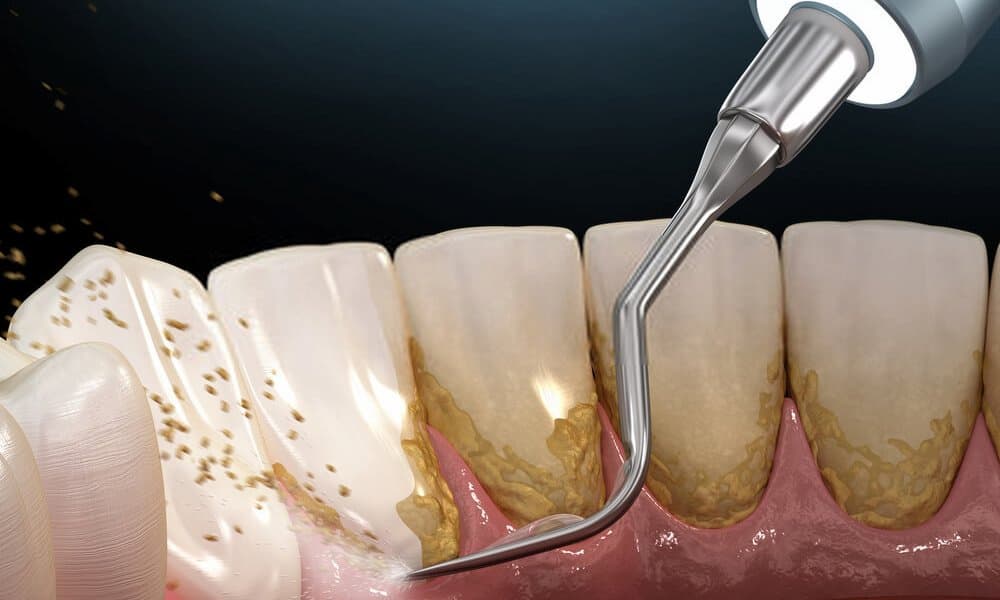What is the best method of scaling teeth? 125434