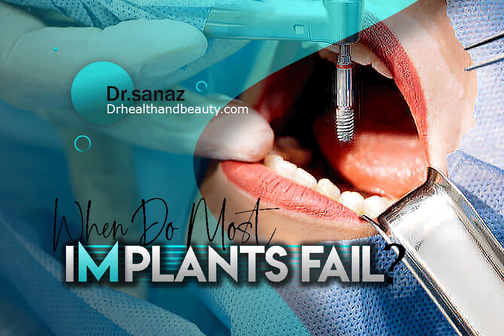 When Do Most Implants Fail?