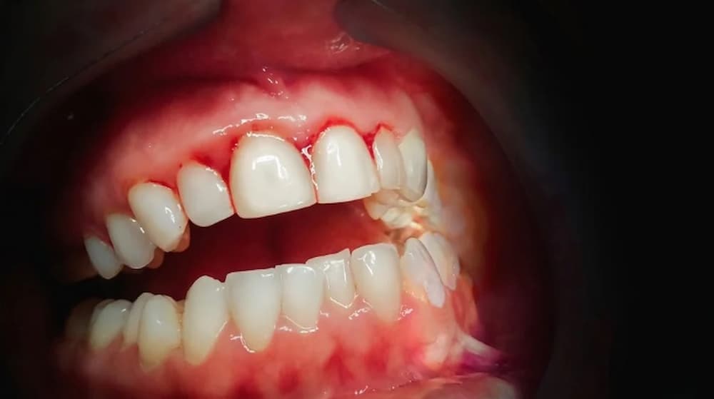 What are the disadvantages of deep cleaning teeth? 05