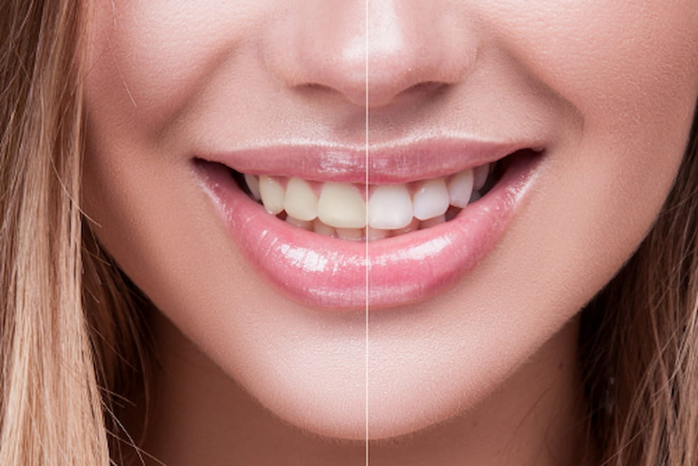 What is the best method of scaling teeth? 1254