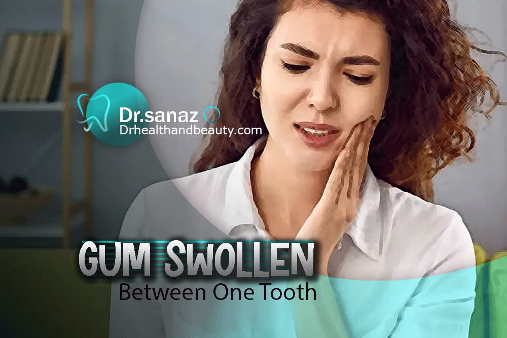 Why Is My Gum Swollen Between One Tooth?