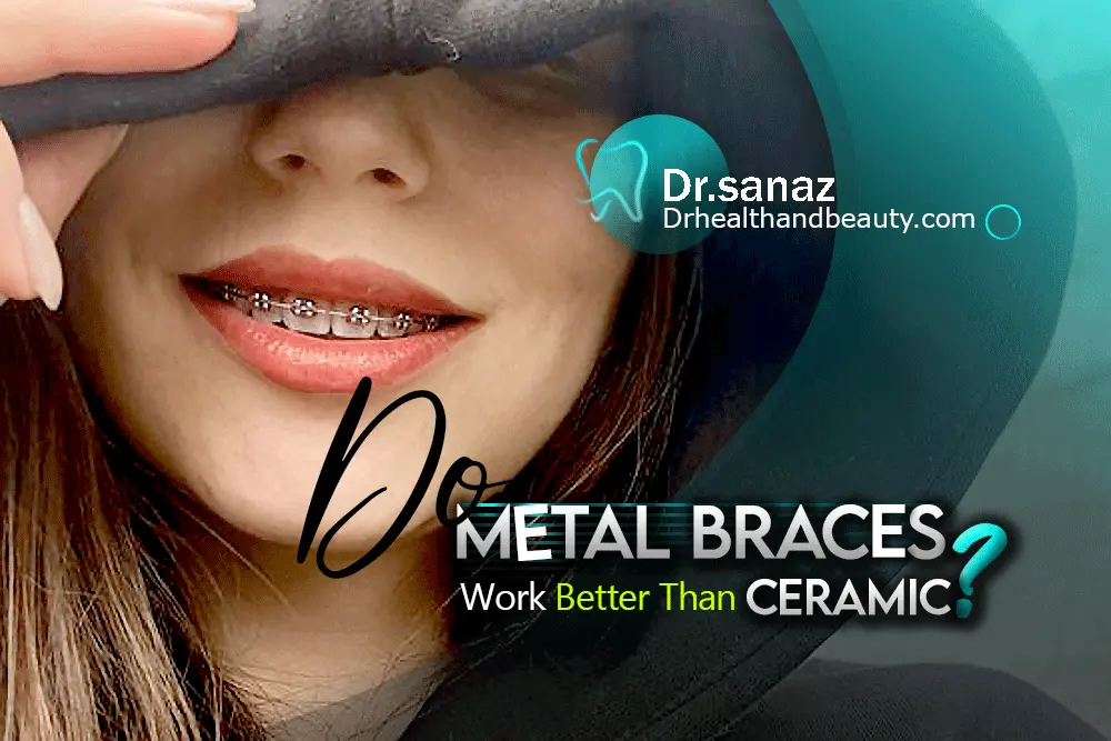 Do Metal Braces Work Better Than Ceramic