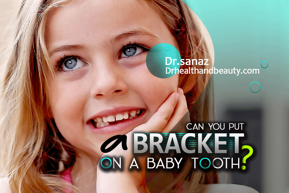 Can-You-Put-A-Bracket-On-A-Baby-Tooth