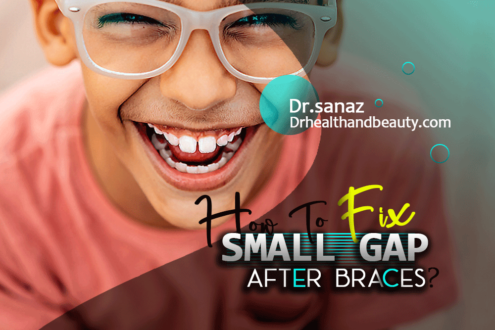 How-To-Fix-A-Small-Gap-After-Braces